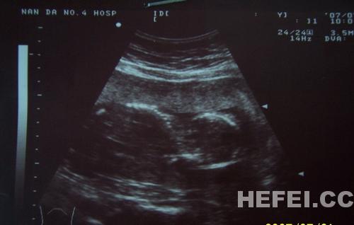 在目千呼常规b超检查中大部分克以刊出胎儿是